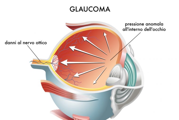 Glaucoma