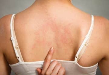 orticaria