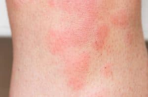 orticaria pomfi