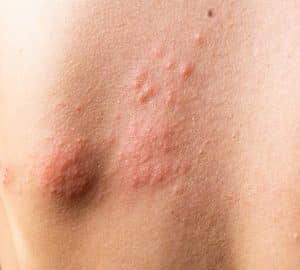 schiena con Orticaria papulosa