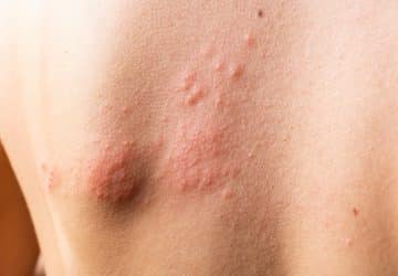 schiena con Orticaria papulosa