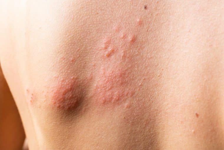 schiena con Orticaria papulosa