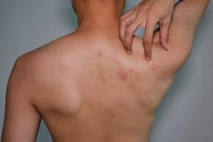 uomo che si gratta sulla spalla per orticaria