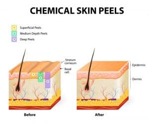 tipologie di peeling
