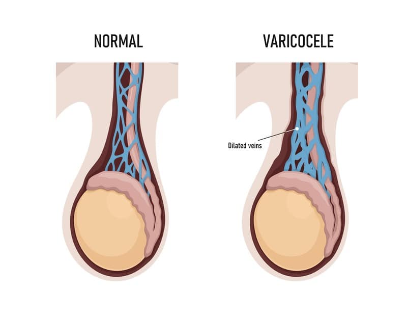 Varicocele vene