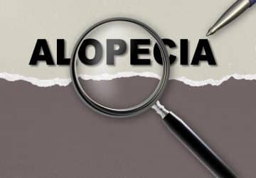 Alopecia