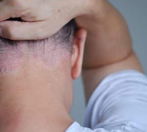 psoriasi del cuoio capelluto