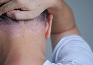 psoriasi del cuoio capelluto