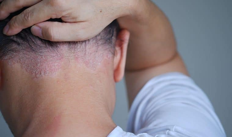 psoriasi del cuoio capelluto