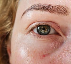 capillari rotti sul viso di donna