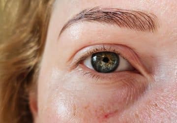 capillari rotti sul viso di donna