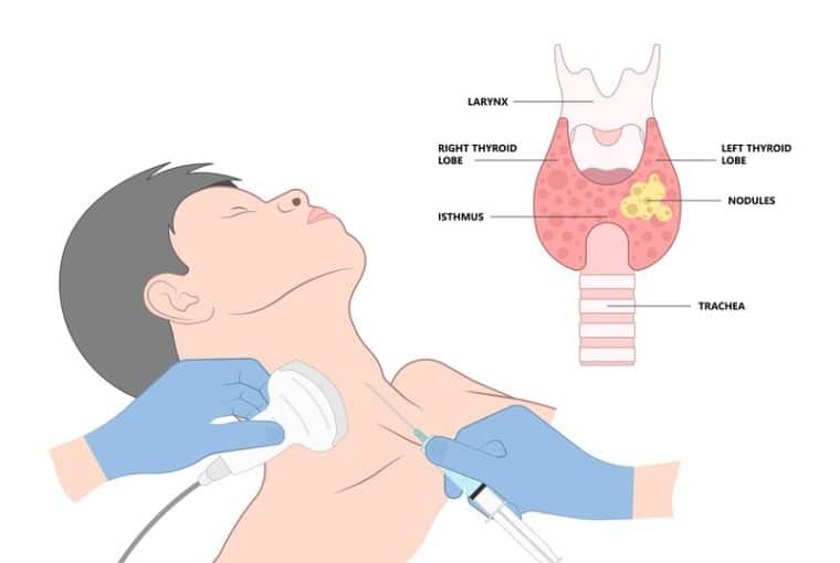 disegno di come funziona l'Agoaspirato della tiroide