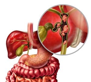 tumore delle vie biliari disegno anatomico