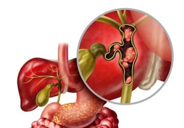 tumore delle vie biliari disegno anatomico