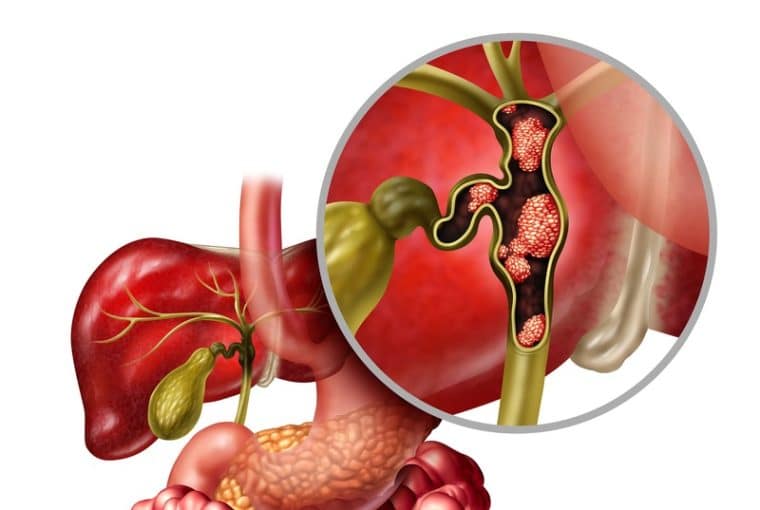 tumore delle vie biliari disegno anatomico