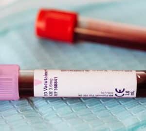 Quando gli anticorpi antifosfolipidi richiedono una diagnosi accurata: Vista ravvicinata di fiale di campioni di sangue su…