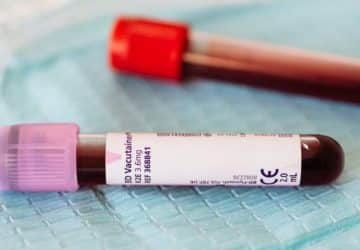 Quando gli anticorpi antifosfolipidi richiedono una diagnosi accurata: Vista ravvicinata di fiale di campioni di sangue su…