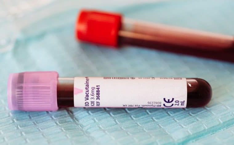 Quando gli anticorpi antifosfolipidi richiedono una diagnosi accurata: Vista ravvicinata di fiale di campioni di sangue su…
